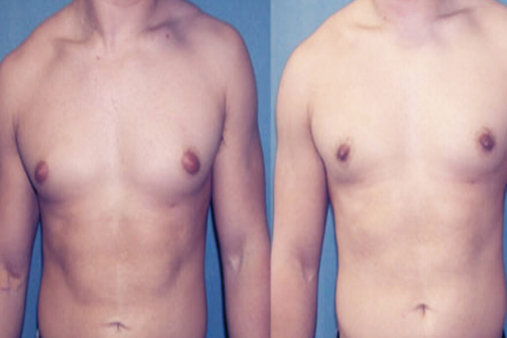 Gynecomastia