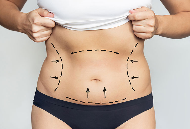 Tummy Tuck Dubai